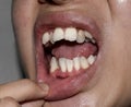 Stacked or overlapping white teeth. Also called crowded teeth Royalty Free Stock Photo