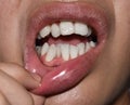Stacked or overlapping white teeth. Also called crowded teeth Royalty Free Stock Photo