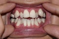 Stacked or overlapping white teeth. Also called crowded teeth Royalty Free Stock Photo