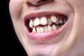 Stacked or overlapping white teeth. Also called crowded teeth Royalty Free Stock Photo