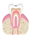 Stage of caries development. Tooth structure in flat style. Tooth decay with enamel. Dental disease realistic vector