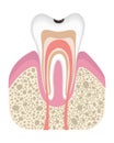 Stage of caries development. Tooth structure in flat style. Tooth decay with enamel. Dental disease realistic vector