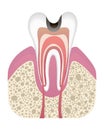 Stage of caries development. Tooth structure in flat style. Tooth decay with enamel. Dental disease realistic vector