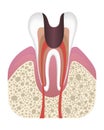 Stage of caries development. Tooth structure in flat style. Tooth decay with enamel. Dental disease realistic vector