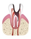 Stage of caries development. Tooth structure in flat style. Tooth decay with enamel. Dental disease realistic vector