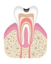 Stage of caries development. Tooth structure in flat style. Tooth decay with enamel. Dental disease realistic vector