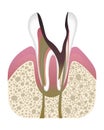 Stage of caries development. Tooth structure in flat style. Tooth decay with enamel. Dental disease realistic vector