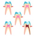 Stage of caries