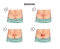 Stage of formation of bedsores