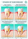 Stage of Gum Disease Royalty Free Stock Photo