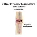 3 Stage Of Healing Bone Fracture. callus ossification. The bone fracture. Infographics. Vector illustration on isolated