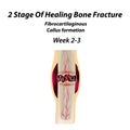 2 Stage Of Healing Bone Fracture. Formation of callus. The bone fracture. Infographics. Vector illustration on isolated Royalty Free Stock Photo