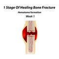 1 Stage Of Healing Bone Fracture. Formation of callus. The bone fracture. Infographics. Vector illustration on isolated Royalty Free Stock Photo