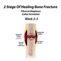 2 Stage Of Healing Bone Fracture. Formation of callus. The bone fracture. Infographics. Vector illustration on isolated