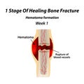 1 Stage Of Healing Bone Fracture. Formation of callus. The bone fracture. Infographics. Vector illustration on isolated