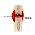 1 Stage Of Healing Bone Fracture. Formation of callus. Hematoma. The bone fracture. Infographics. Vector illustration on Royalty Free Stock Photo