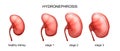 The stage of hydronephrosis