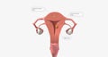 Stage I endometrial cancer begins in the endometrium and spreads to the myometrium of the uterus