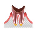 The stage of tooth decay illustration / Dead tooth Royalty Free Stock Photo