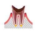 The stage of tooth decay illustration / Dead tooth