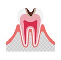 The stage of tooth decay illustration / Decay in dentin Royalty Free Stock Photo