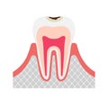 The stage of tooth decay illustration/ Decay in enamel