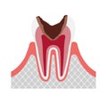 The stage of tooth decay illustration / Decay in pulp