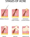 Stages of acne formation in the human skin