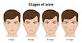 Stages of acne