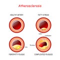 Stages of atherosclerosis. Cholesterol in artery