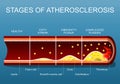 Stages of atherosclerosis. Close-up of an Arterial wall Royalty Free Stock Photo