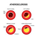Stages of atherosclerosis. Royalty Free Stock Photo
