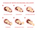 Stages of baby birth in vaginal delivery Royalty Free Stock Photo
