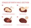 Stages of baby birth via cesarean section Royalty Free Stock Photo