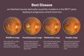 Stages of Best vitelliform macular dystrophy, 3D illustration