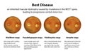 Stages of Best vitelliform macular dystrophy, illustration