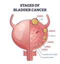 Stages of bladder cancer with anatomical oncology model outline diagram