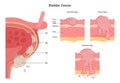 Stages of bladder cancer. Human internal organ wall with a developing