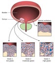 Stages of bladder cancer
