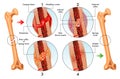 Stages of bone fracture repair