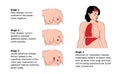 Stages of breast cancer