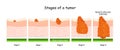 Stages of cancer. Classification of Malignant Tumours