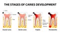 Stages of caries development Royalty Free Stock Photo