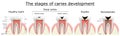 Stages of caries development. Dental disease: caries, pulpitis and periodontitis, realistic vector illustration