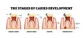 Stages of caries development stages. Labeled enamel, dentin caries, pulpitis, periodontitis. Infected pulp. Tooth structure Royalty Free Stock Photo