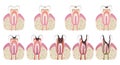 Stages of caries development. Tooth structure in flat style. Tooth decay with enamel. Dental disease caries, pulpitis Royalty Free Stock Photo