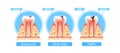 Stages Of Caries Infographics. Enamel Caries, Dentin Caries, And Pulpitis Cross Section View. Medical Visual Information