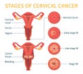 Stages of cervical cancer vector white scheme