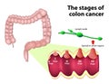 The Stages of Colorectal Cancer