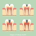 Stages of decay tooth anatomy structure including the bone and gum Royalty Free Stock Photo